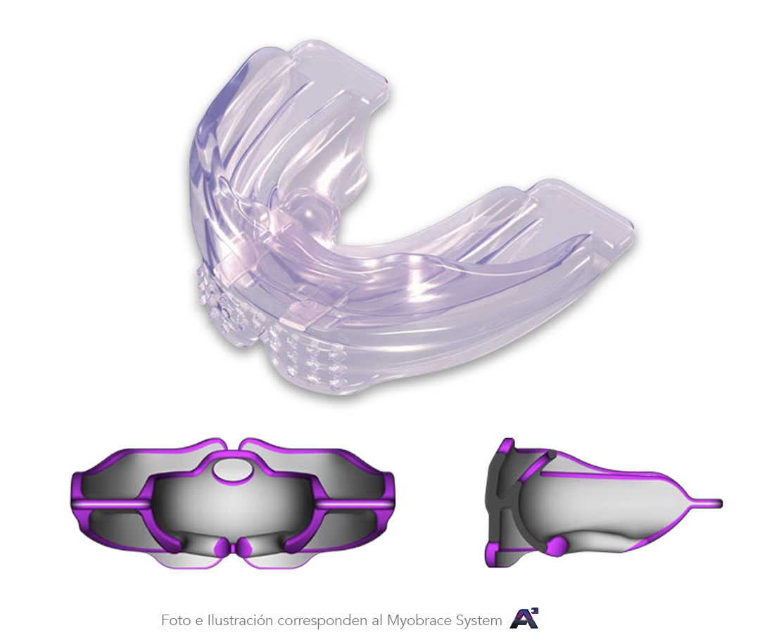 Myobrace - Pacific Orthodontics